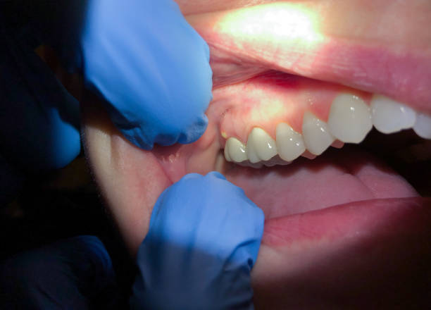 Best Emergency Root Canal Treatment in Macon, GA